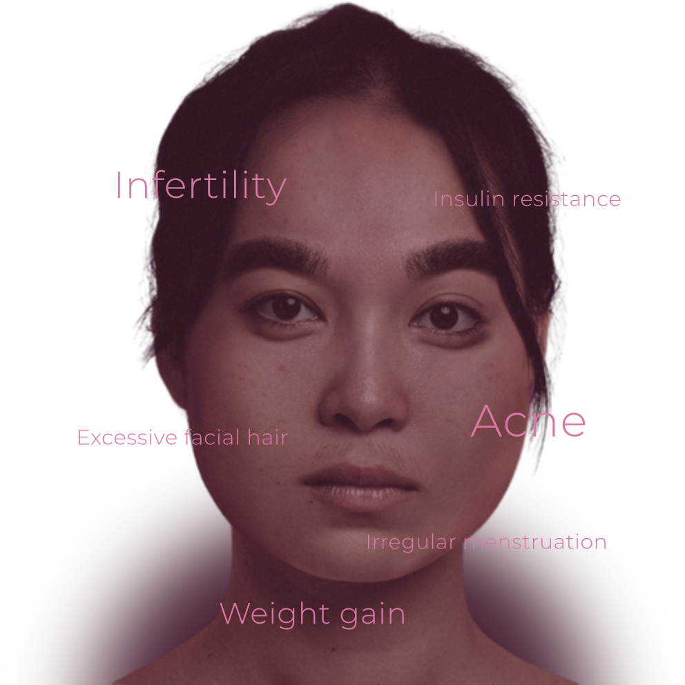 It’s not you. It’s your PCOS.